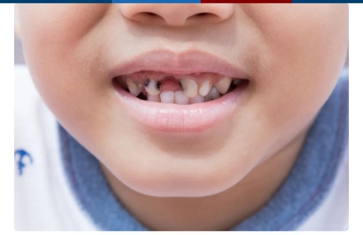 ७३ प्रतिशत बालबालिकामा दाँत किराले खाने समस्या